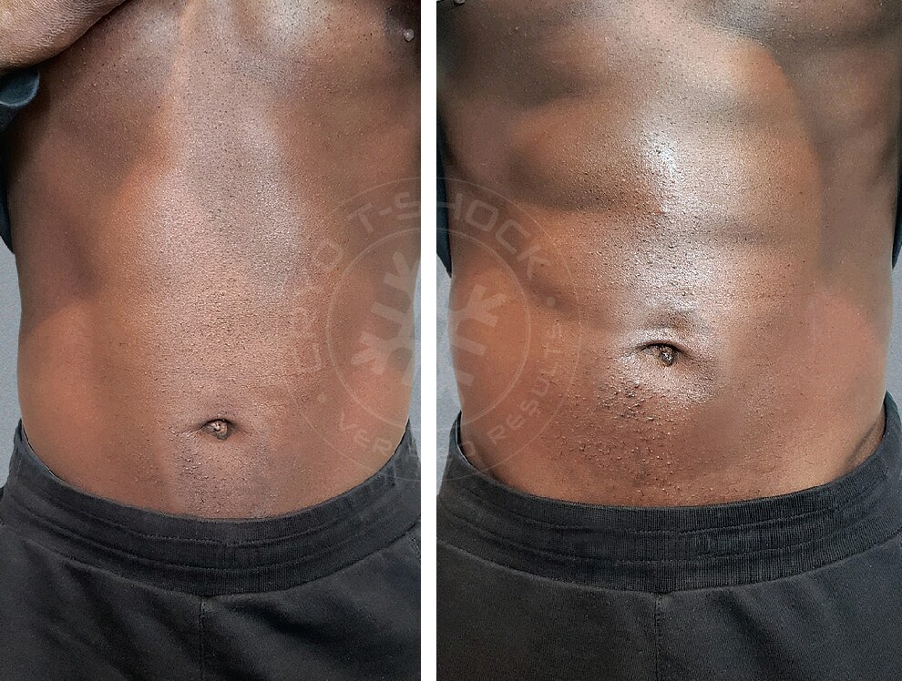 Before and after body contouring — abdominal definition