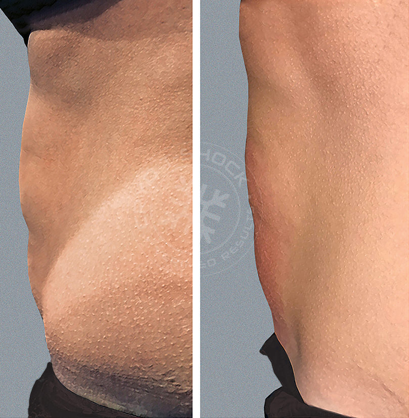 Before and after body contouring — flank