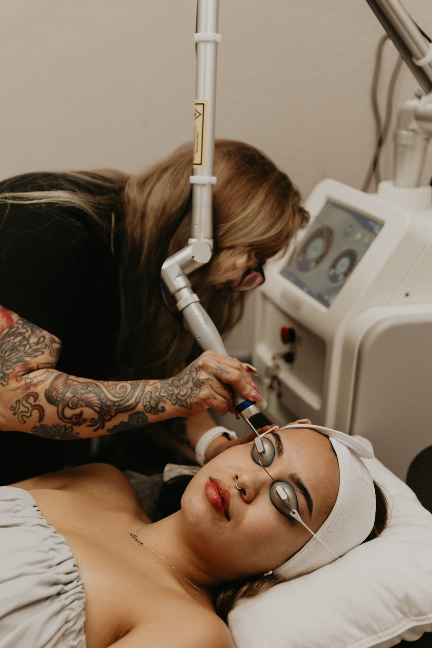 A PicoWay treatment in progress at ARO Med Spa
