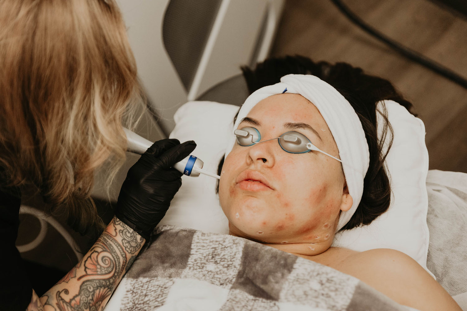 Pigmentation treatment at ARO MedSpa